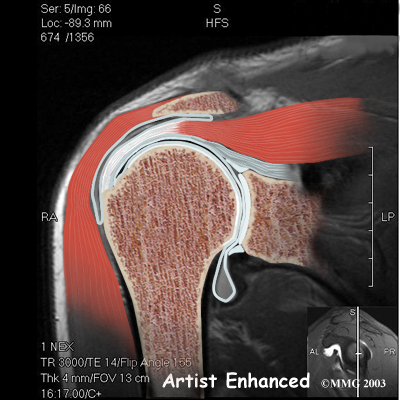 Physiotherapy in Beamsville for Shoulder Impingement Syndrome