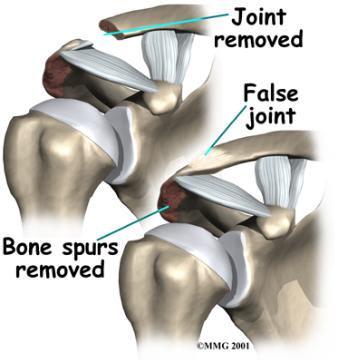 Physiotherapy in Beamsville for Shoulder Impingement Syndrome